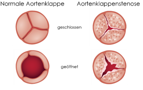 Aortenklappenstenose